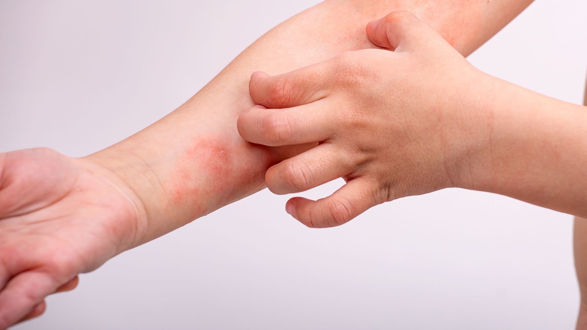 Atopický ekzém: Zdravotný problém, ktorý je potrebné riešiť čím skôr!